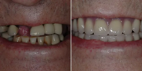 All-on-4 / Full Arch before and after — St. George Center for Specialized Dentistry, St. George, UT