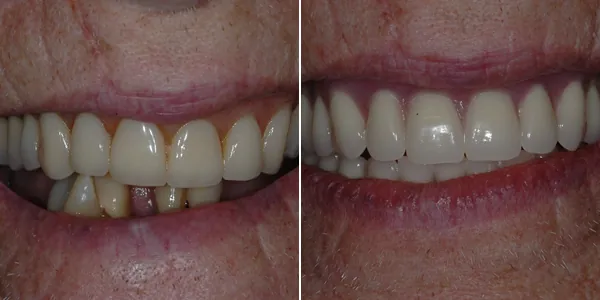 All-on-4 / Full Arch before and after — St. George Center for Specialized Dentistry, St. George, UT