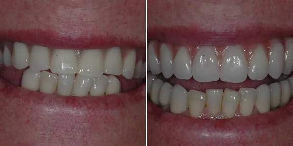 All-on-4 / Full Arch before and after — St. George Center for Specialized Dentistry, St. George, UT