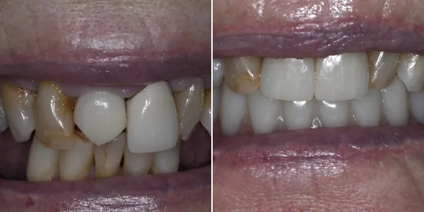 All-on-4 / Full Arch before and after — St. George Center for Specialized Dentistry, St. George, UT
