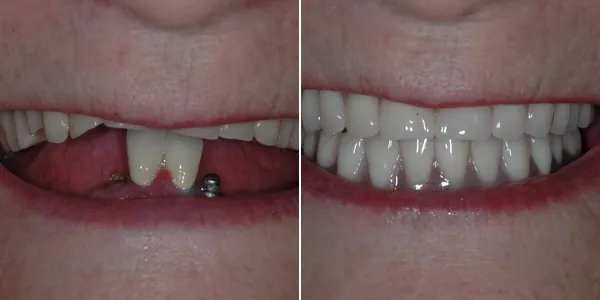 All-on-4 / Full Arch before and after — St. George Center for Specialized Dentistry, St. George, UT
