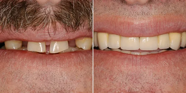 Crowns before and after — St. George Center for Specialized Dentistry, St. George, UT