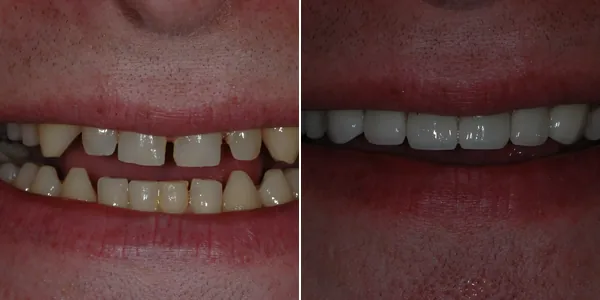 Crowns before and after — St. George Center for Specialized Dentistry, St. George, UT