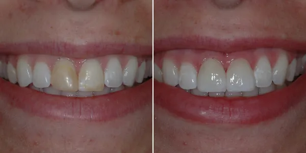 Crowns before and after — St. George Center for Specialized Dentistry, St. George, UT