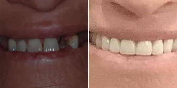 Crowns before and after — St. George Center for Specialized Dentistry, St. George, UT