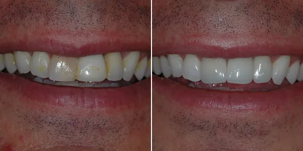 Dental Implants before and after — St. George Center for Specialized Dentistry, St. George, UT