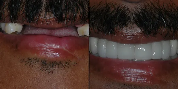 Dental Implants before and after — St. George Center for Specialized Dentistry, St. George, UT