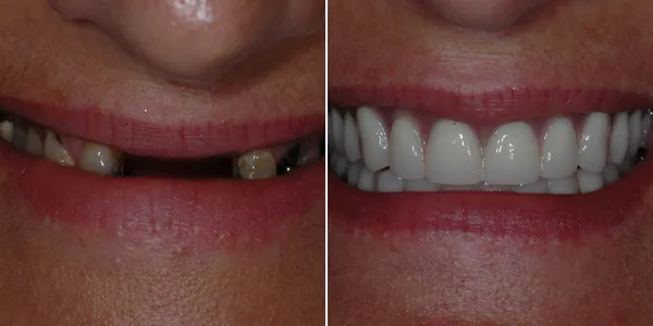 Dentures before and after — St. George Center for Specialized Dentistry, St. George, UT