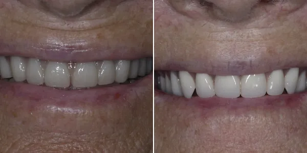 Dentures before and after — St. George Center for Specialized Dentistry, St. George, UT