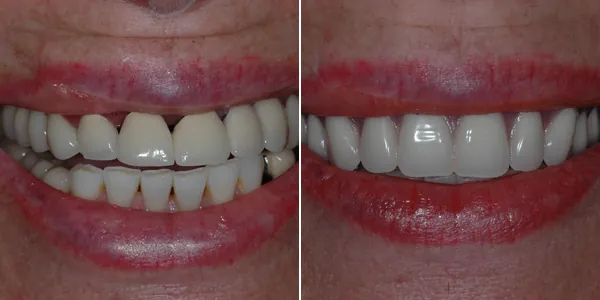 Dentures before and after — St. George Center for Specialized Dentistry, St. George, UT