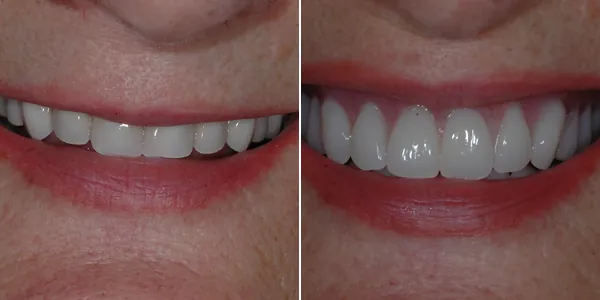 Dentures before and after — St. George Center for Specialized Dentistry, St. George, UT