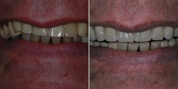 Dentures before and after — St. George Center for Specialized Dentistry, St. George, UT