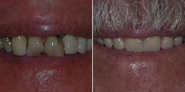 Dentures before and after — St. George Center for Specialized Dentistry, St. George, UT