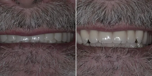 Dentures before and after — St. George Center for Specialized Dentistry, St. George, UT