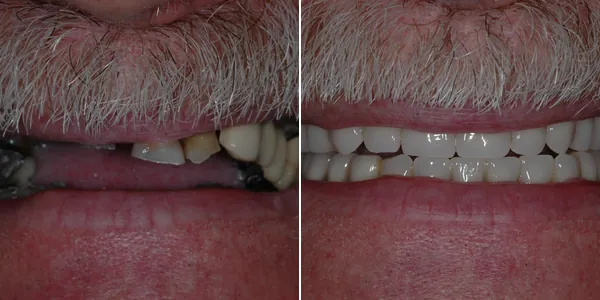 Dentures before and after — St. George Center for Specialized Dentistry, St. George, UT