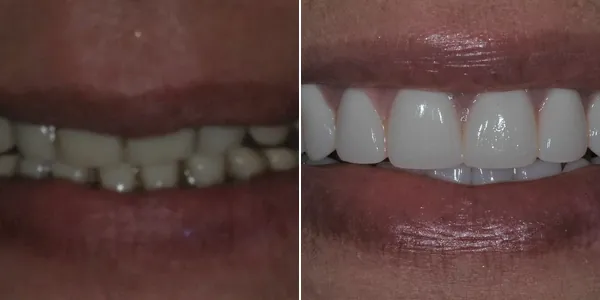 Dentures before and after — St. George Center for Specialized Dentistry, St. George, UT