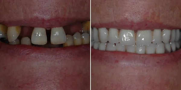 Dentures before and after — St. George Center for Specialized Dentistry, St. George, UT
