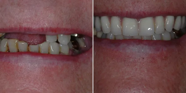 Dentures before and after — St. George Center for Specialized Dentistry, St. George, UT