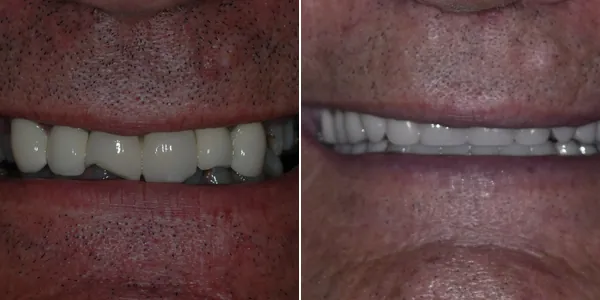 Dentures before and after — St. George Center for Specialized Dentistry, St. George, UT