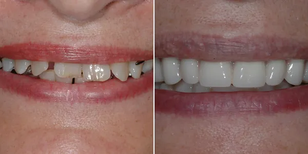 Dentures before and after — St. George Center for Specialized Dentistry, St. George, UT