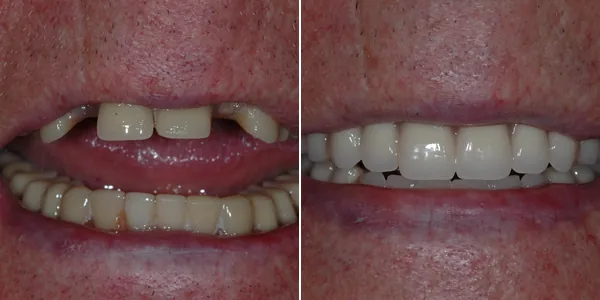 Dentures before and after — St. George Center for Specialized Dentistry, St. George, UT