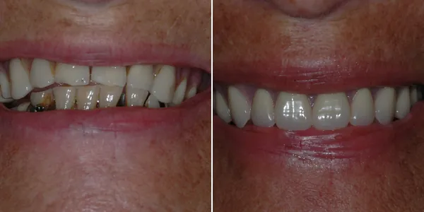 Dentures before and after — St. George Center for Specialized Dentistry, St. George, UT