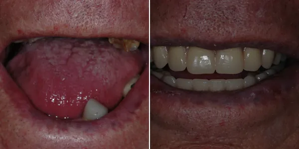 Dentures before and after — St. George Center for Specialized Dentistry, St. George, UT