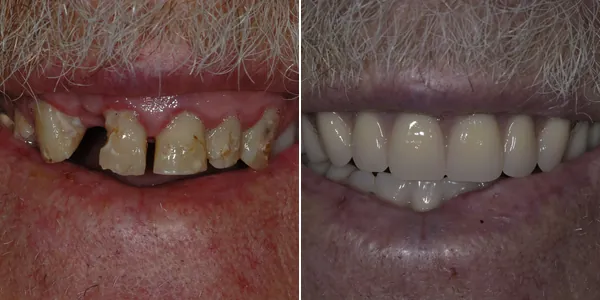 Dentures before and after — St. George Center for Specialized Dentistry, St. George, UT