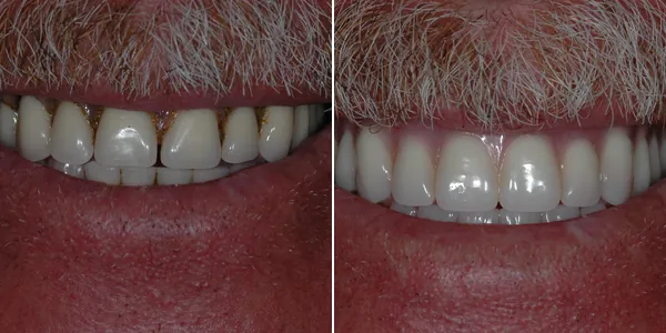 Dentures before and after — St. George Center for Specialized Dentistry, St. George, UT