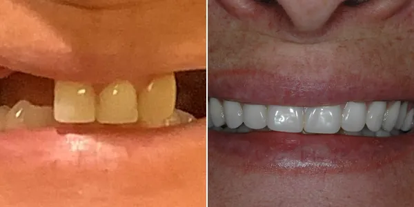 Dentures before and after — St. George Center for Specialized Dentistry, St. George, UT