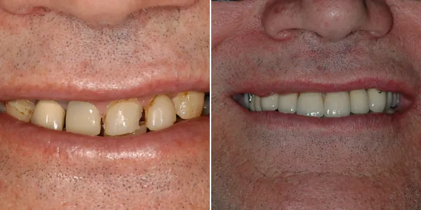Full Mouth Reconstruction before and after — St. George Center for Specialized Dentistry, St. George, UT