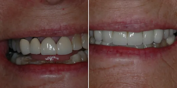 Full Mouth Reconstruction before and after — St. George Center for Specialized Dentistry, St. George, UT
