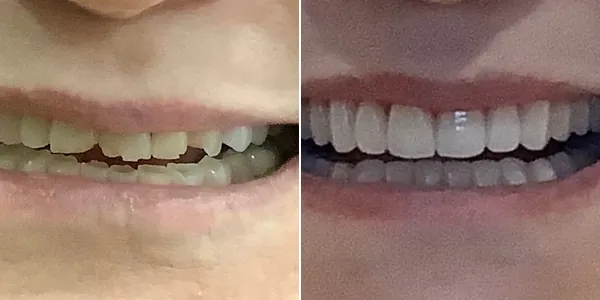 Full Mouth Reconstruction before and after — St. George Center for Specialized Dentistry, St. George, UT