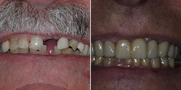 Full Mouth Reconstruction before and after — St. George Center for Specialized Dentistry, St. George, UT