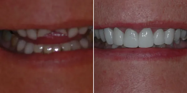 Full Mouth Reconstruction before and after — St. George Center for Specialized Dentistry, St. George, UT