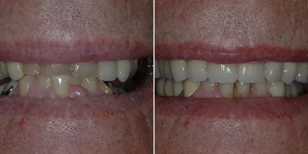 Full Mouth Reconstruction before and after — St. George Center for Specialized Dentistry, St. George, UT