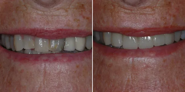 Full Mouth Reconstruction before and after — St. George Center for Specialized Dentistry, St. George, UT
