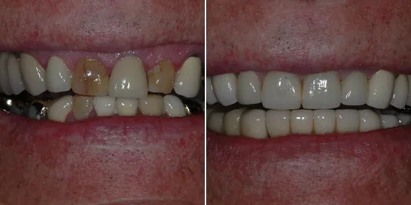 Full Mouth Reconstruction before and after — St. George Center for Specialized Dentistry, St. George, UT