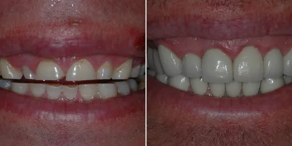 Full Mouth Reconstruction before and after — St. George Center for Specialized Dentistry, St. George, UT