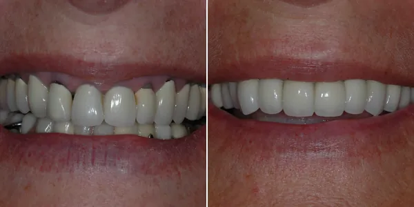Full Mouth Reconstruction before and after — St. George Center for Specialized Dentistry, St. George, UT