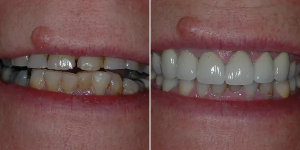 Full Mouth Reconstruction before and after — St. George Center for Specialized Dentistry, St. George, UT