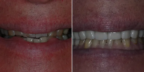Full Mouth Reconstruction before and after — St. George Center for Specialized Dentistry, St. George, UT