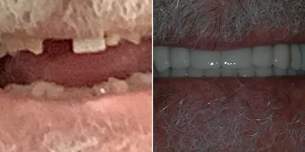 Full Mouth Reconstruction before and after — St. George Center for Specialized Dentistry, St. George, UT