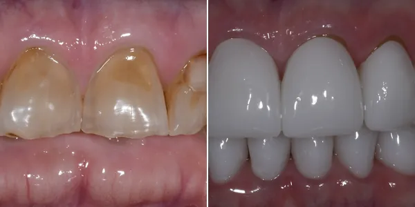 Full Mouth Reconstruction before and after — St. George Center for Specialized Dentistry, St. George, UT