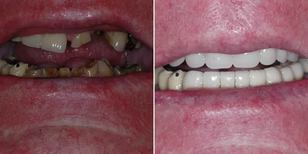 Full Mouth Reconstruction before and after — St. George Center for Specialized Dentistry, St. George, UT