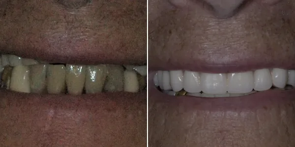 Full Mouth Reconstruction before and after — St. George Center for Specialized Dentistry, St. George, UT