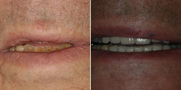 Full Mouth Reconstruction before and after — St. George Center for Specialized Dentistry, St. George, UT