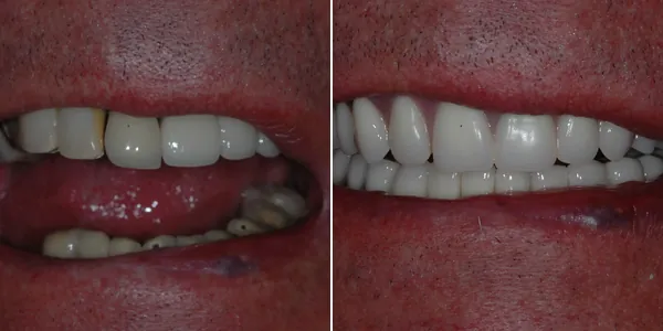 Full Mouth Reconstruction before and after — St. George Center for Specialized Dentistry, St. George, UT