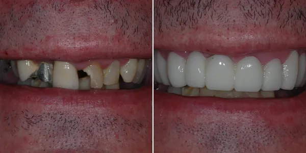 Other before and after — St. George Center for Specialized Dentistry, St. George, UT
