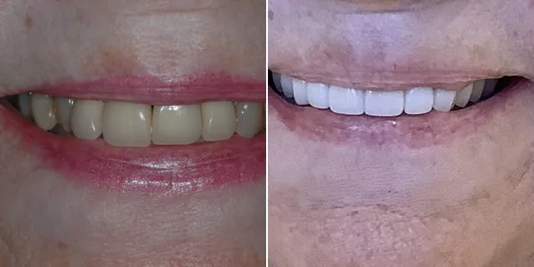 Smile Makeover (multiple procedures) before and after — St. George Center for Specialized Dentistry, St. George, UT